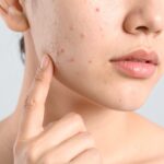 Bare glowing summer skin by looking out for these common skin woes
